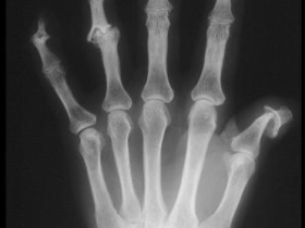 男性,38岁。周身脱屑性皮疹6年,近年逐渐出现远端指间关节、近端指间关节和右膝关节肿痛,伴活动受限,查体指甲可见顶针样凹陷,头皮发迹及四肢躯干皮肤可见小片状鳞屑样皮疹。